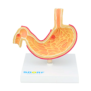 MODELO PATOLÓGICO DO ESTÔMAGO - SD5207 - SDORF