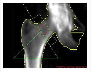 Densitometria Óssea – Fêmur