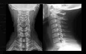 RX da Coluna Cervical - AP/PERFIL