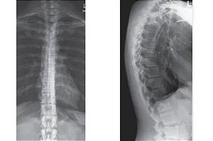 Rx da Coluna Torácica/Dorsal - AP/PERFIL