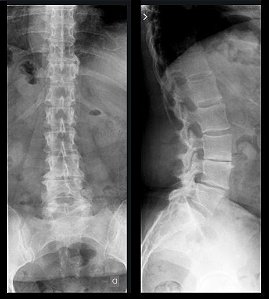 Rx da Coluna Lombar - AP/PERFIL