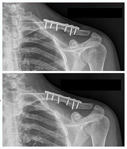 Rx da Clavícula (unilateral)