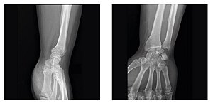 Rx do Punho (unilateral)