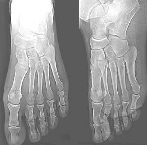 Rx do Pé (unilateral)