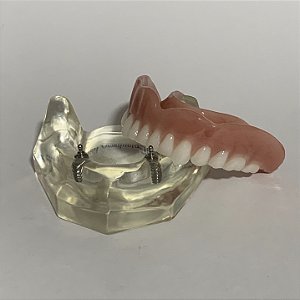 Manequim Odontológico Overdenture O-Ring Inferior