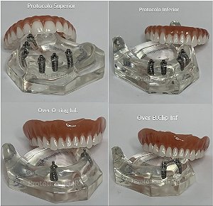Manequins  Odontológicos 2 Protocolos, Overs O-Ring e Barra Clipe 2 Implantes