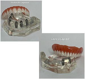 Manequins Modelos Odontológicos Protocolo 6 Implantes e Overdenture Barra Clipe 2 Implantes