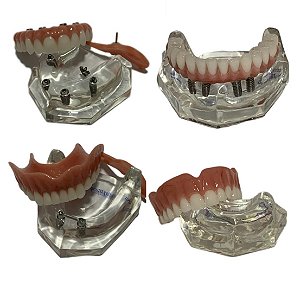 Manequins Protocolo Sup. 4 Impl.(All-On-Four). Protocolo Inf.  4 Impl. Overdenture Barra Clip e Prótese Total Sup. Kit c/ 4
