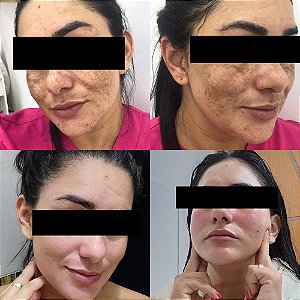 Kit 10x Gel para Peeling Clareador Belladona com Ácido Retinóico 30G - ORIGINAL
