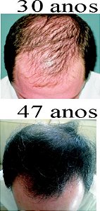 Alopécia Androgênica (queda de cabelos)