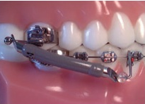 Aparelho de Avanço Mandibular Propulsor Jasper Jumper Marca American Orthodontics