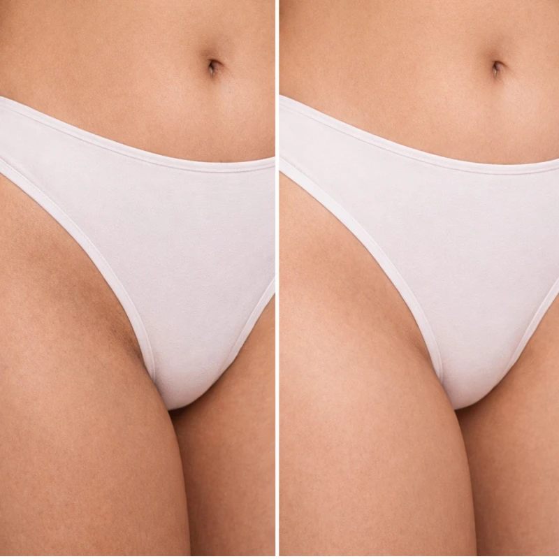 Antes e depois - Clareador com Inibidor de Pelos LABOTRAT para virilha e linha do biquíni