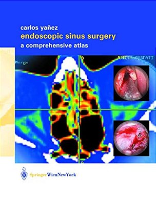 Endoscopic Sinus Surgery: A Comprehensive Atlas-..