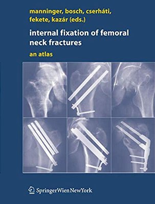 Internal Fixation Of Femoral Neck Fractures: An Atlas-..