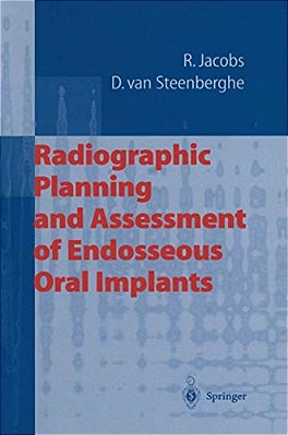 Radiographic Planning And Assessment Of Endosseous Oral Implants-..