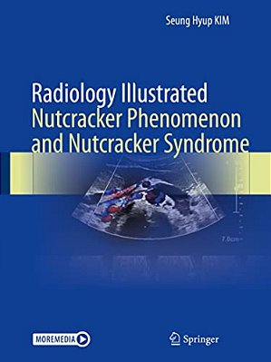 Radiology Illustrated: Nutcracker Phenomenon And Nutcracker Syndrome-..