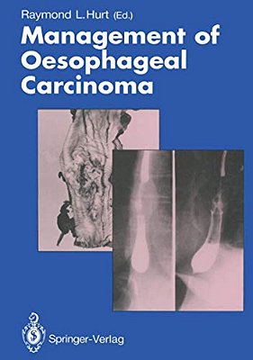 Management Of Oesophageal Carcinoma-..
