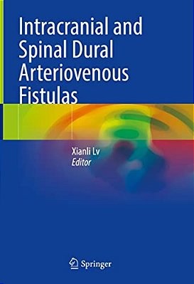Intracranial And Spinal Dural Arteriovenous Fistulas-..