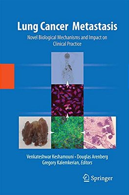 Lung Cancer Metastasis: Novel Biological Mechanisms And Impact On Clinical Practice-..
