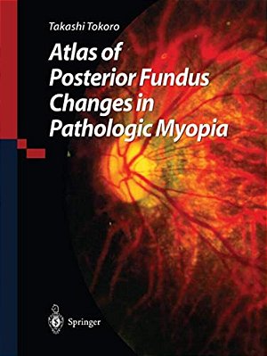 Atlas Of Posterior Fundus Changes In Pathologic Myopia-..