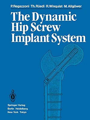 The Dynamic Hip Screw Implant System-..