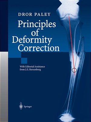 Principles Of Deformity Correction-..