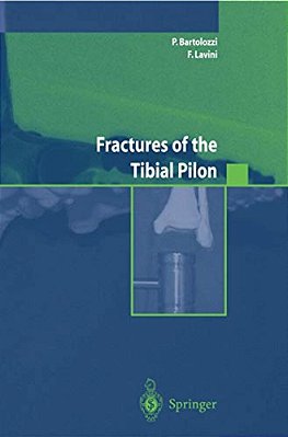 Fractures Of The Tibial Pilon-..