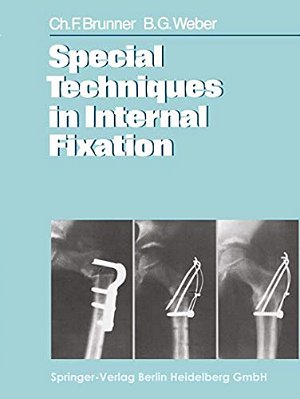 Special Techniques In Internal Fixation-..