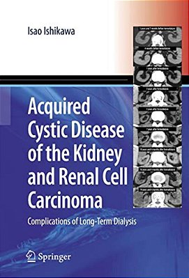 Acquired Cystic Disease Of The Kidney And Renal Cell Carcinoma: Complication Of Long-Term Dialysis-..