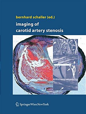 Imaging Of Carotid Artery Stenosis-..