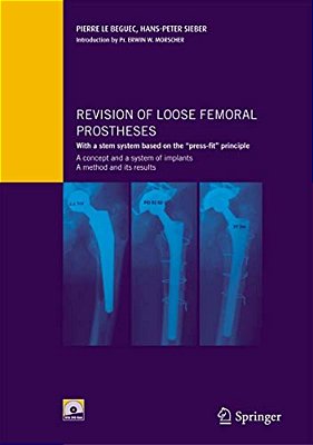 Revision Of Loose Femoral Prostheses With A Stem System Based On The Press-Fit Principle: A Concept And Its System Of Implants, A Method And Its Resul-..
