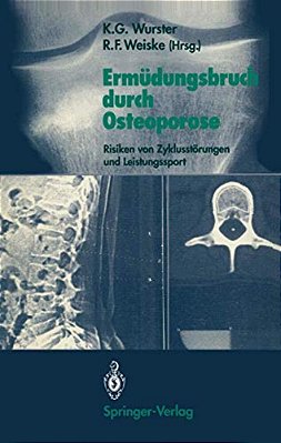 Ermüdungsbruch Durch Osteoporose: Risiken Von Zyklusstörungen Und Leistungssport-..