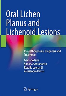 Oral Lichen Planus And Lichenoid Lesions: Etiopathogenesis, Diagnosis And Treatment-..