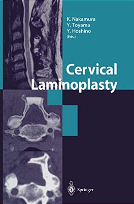 Cervical Laminoplasty-..