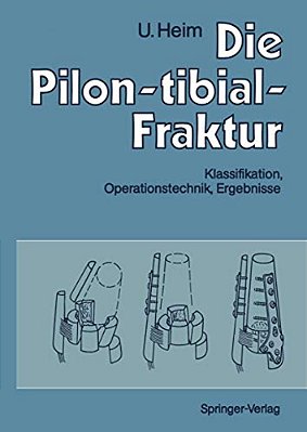 Die Pilon-Tibial-fraktur: Klassifikation, Operationstechnik, Ergebnisse-..
