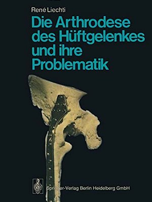Die Arthrodese Des Hüftgelenkes Und Ihre Problematik-..