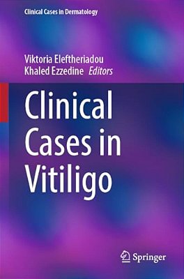 Clinical Cases In Vitiligo-..