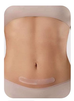 Fita de Silicone P/ Cicatriz e Queloide 15 x 2cm C/4 Unid - Siliskin