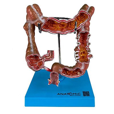 Intestino Grosso com Patologia - TGD-0329-G