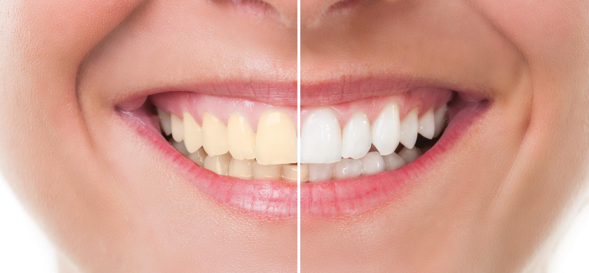clareador-dental-miracle-teeth-natural-whitener-tonamodaimports