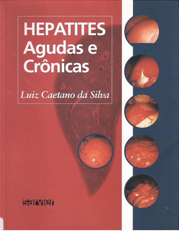 Hepatites Agudas E Crônicas
