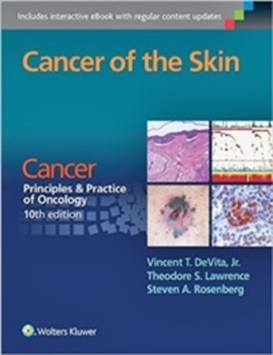 Cancer Of The Skin - Cancer, Principles And Practice Of Oncology-..