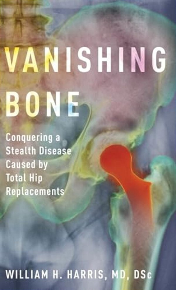 Vanishing Bone: Conquering A Stealth Disease Caused By Total Hip Replacements-..