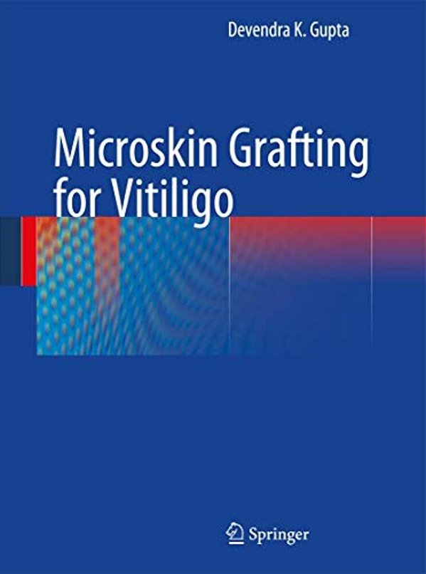 Microskin Grafting For Vitiligo-..