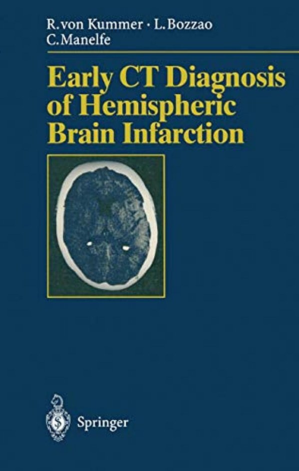 Early Ct Diagnosis Of Hemispheric Brain Infarction-..