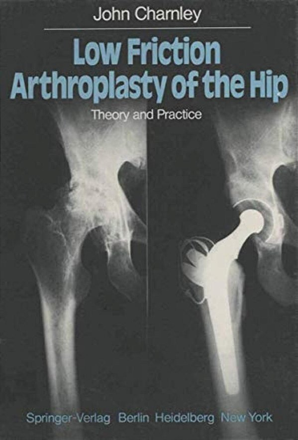 Low Friction Arthroplasty Of The Hip: Theory And Practice-..