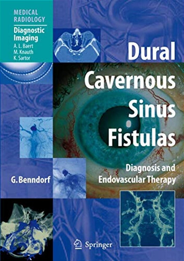 Dural Cavernous Sinus Fistulas: Diagnosis And Endovascular Therapy-..