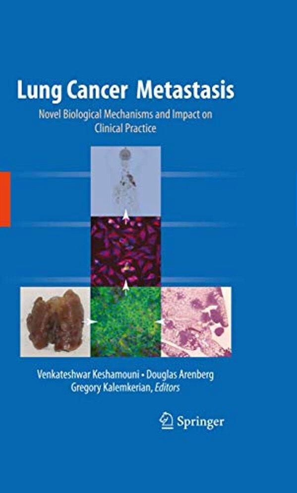 Lung Cancer Metastasis: Novel Biological Mechanisms And Impact On Clinical Practice-..