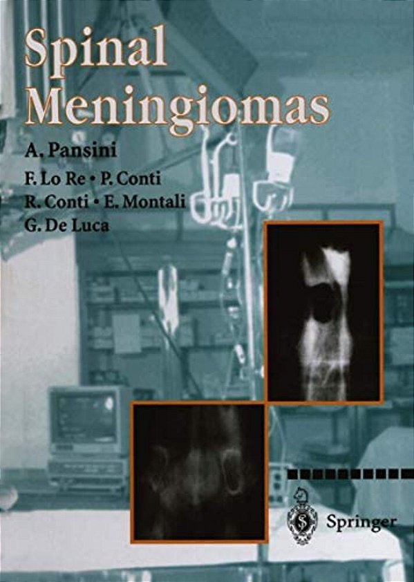 Spinal Meningiomas-..