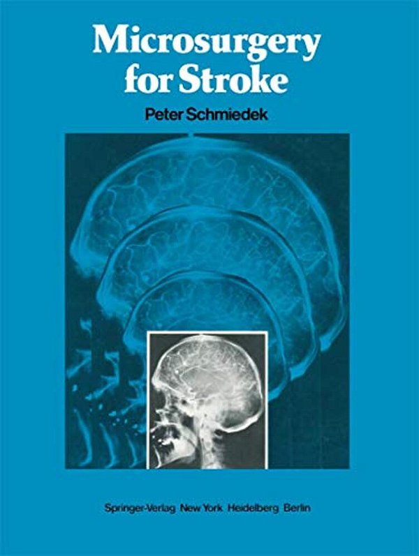 Microsurgery For Stroke-..